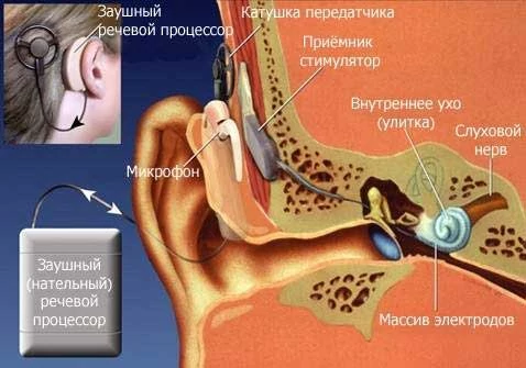 Кохлеарный имплант и его расположение